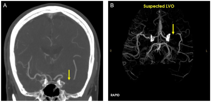  The yellow arrow in both images points to a blocked vessel (large vessel occlusion, or LVO) in the brain; A) shows the image analyzed by human providers, and B) shows the blockage detected by AI. "This is a true positive confirmed by ... ground truth," researchers concluded. Credit: Front Neurol. 2023; 14: 1179250.