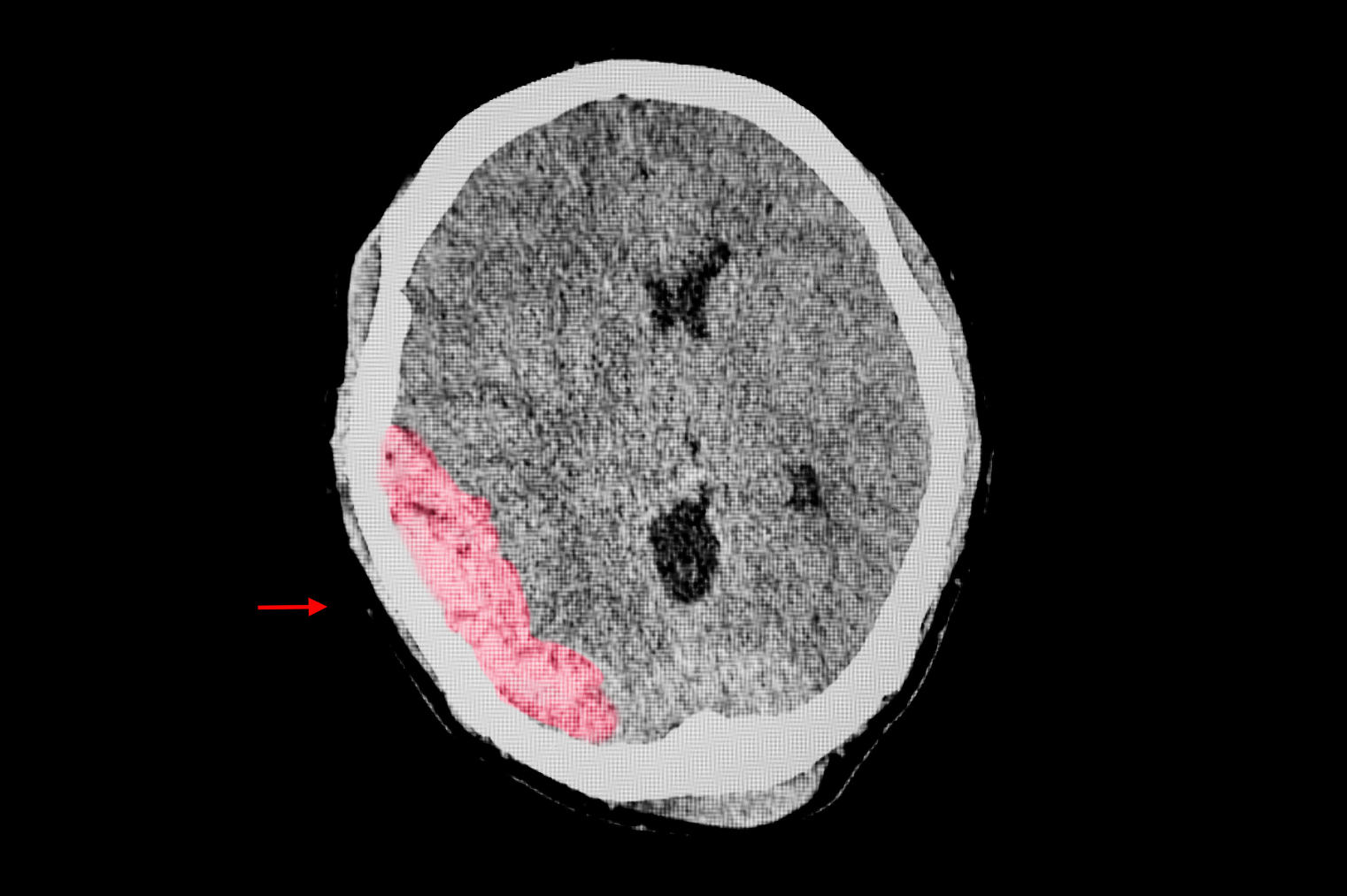 UC Noyce TBI MRI