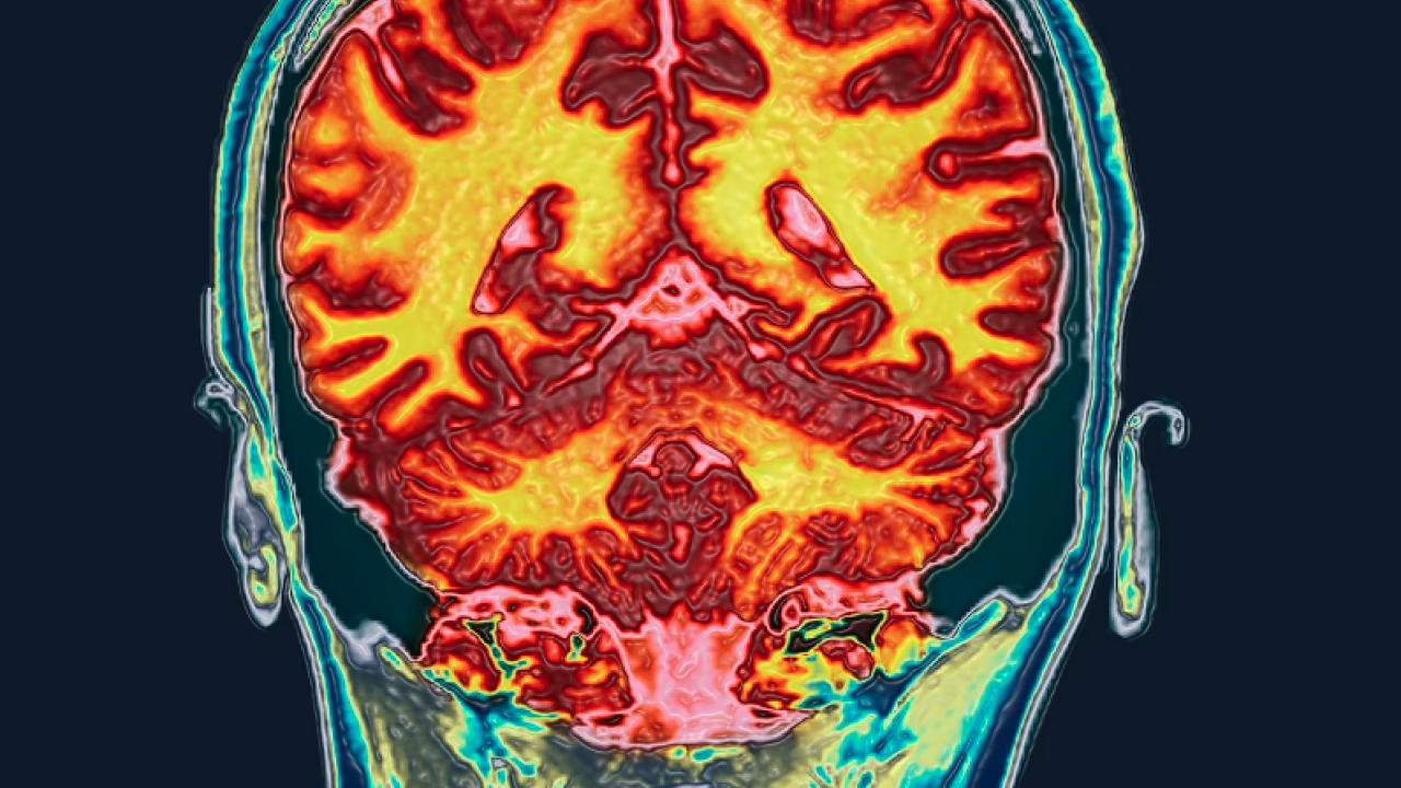 Colored coronal magnetic resonance imaging (MRI) scan of the brain of a healthy.
